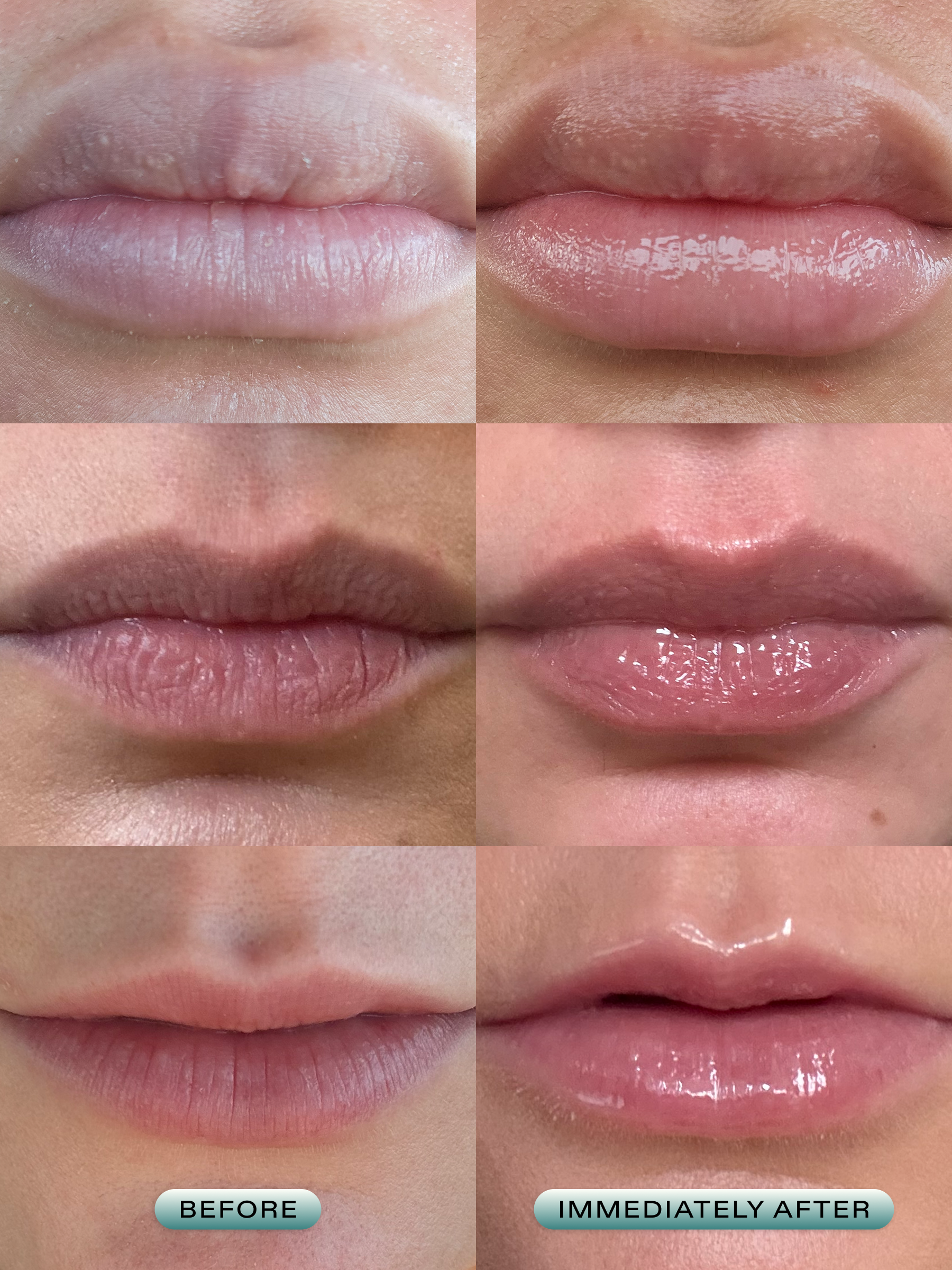 Lip Barrier Relief - Image 5